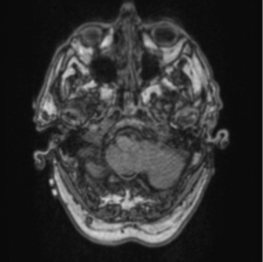File:Cerebellar metastasis from lung adenocarcinoma (Radiopaedia 86690-102829 Axial T1 15).png