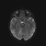 File:Cerebellar stroke (Radiopaedia 32202-33150 Axial DWI 10).png