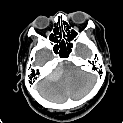 Cerebellopontine angle meningioma (Radiopaedia 35181-36714 A 28).jpg