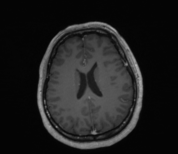 Cerebellopontine angle meningioma (Radiopaedia 35181-36715 Axial T1 C+ 22).jpg