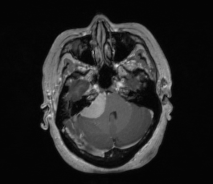 Cerebellopontine angle meningioma (Radiopaedia 35181-36715 Axial T1 C+ 41).jpg