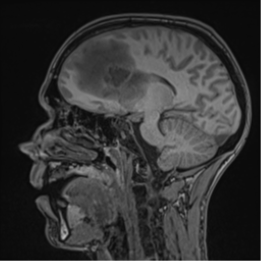 Cerebral abscess (Radiopaedia 60342-68009 Sagittal T1 33).png