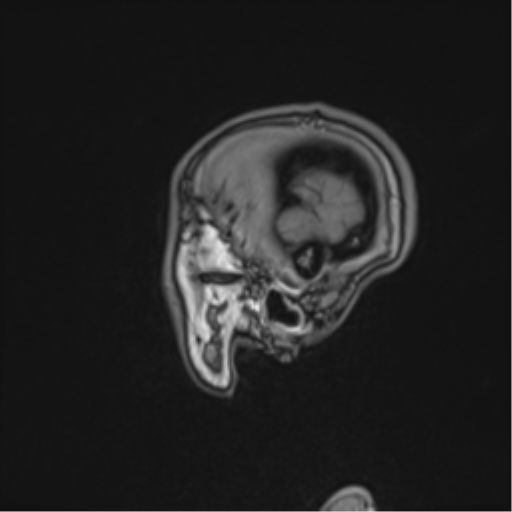Cerebral abscess (Radiopaedia 60342-68009 Sagittal T1 51).png