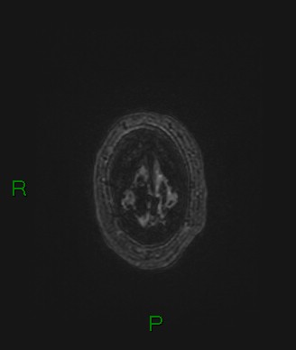 Cerebral abscess and subdural empyema (Radiopaedia 84436-99779 Axial FLAIR 9).jpg
