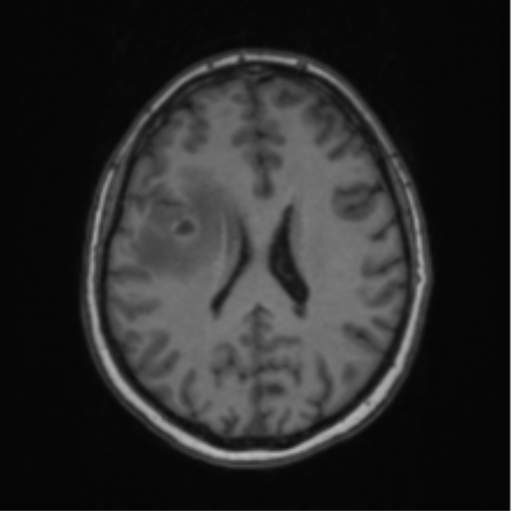 File:Cerebral abscess from pulmonary arteriovenous malformation (Radiopaedia 86275-102291 Axial T1 47).png