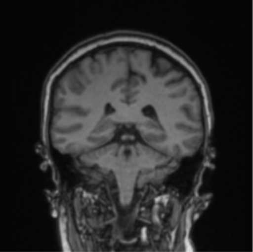Cerebral abscess from pulmonary arteriovenous malformation (Radiopaedia 86275-102291 Coronal T1 36).png