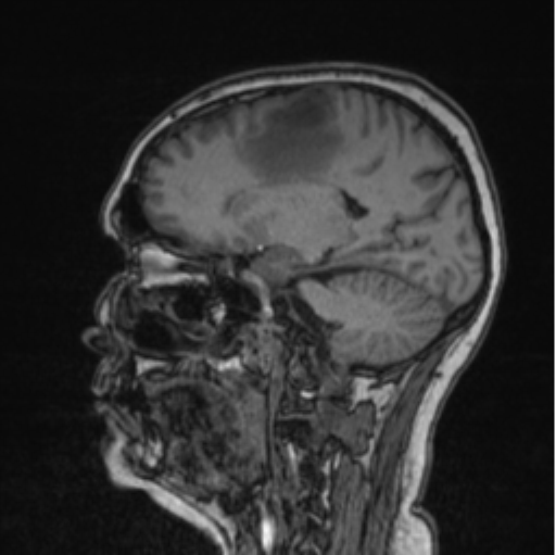 Cerebral abscess from pulmonary arteriovenous malformation (Radiopaedia 86275-102291 Sagittal T1 60).png