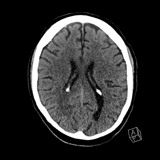 Cerebral abscess with ventriculitis (Radiopaedia 78965-91876 Axial non-contrast 30).jpg