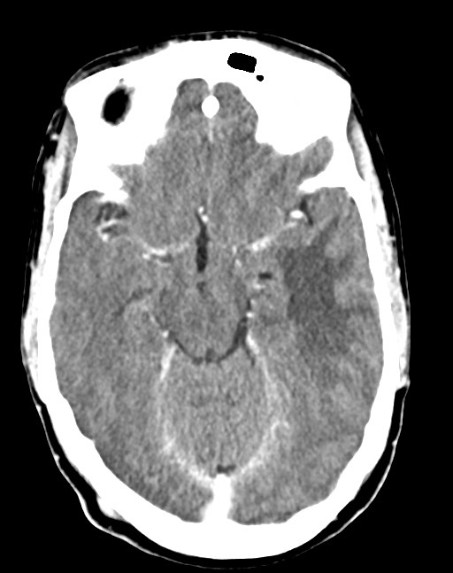 Cerebral abscesses (Radiopaedia 70458-80568 Axial Contrast 26).jpg