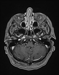 Cerebral amyloid angiopathy-related inflammation (Radiopaedia 58270-65377 Axial T1 C+ fat sat 21).jpg