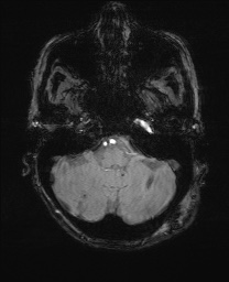 File:Cerebral amyloid angiopathy-related inflammation (Radiopaedia 74836-85849 Axial SWI 14).jpg