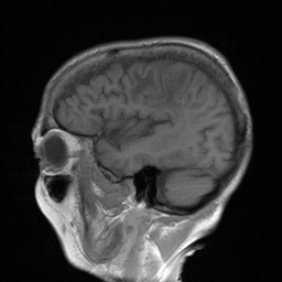 File:Cerebral amyloid angiopathy-related inflammation (Radiopaedia 74836-85849 Sagittal T1 10).jpg