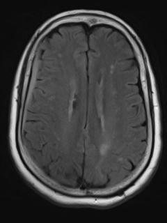 File:Cerebral amyloid angiopathy (Radiopaedia 29129-29518 Axial FLAIR 14).jpg