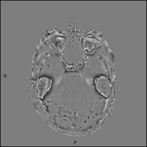 Cerebral amyloid angiopathy (Radiopaedia 77506-89664 H 37).jpg