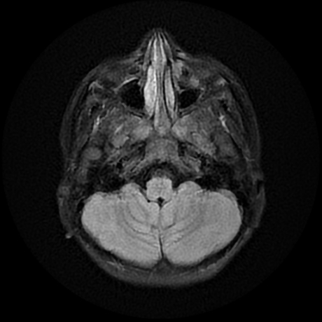 File:Cerebral and spinal tuberculosis (Radiopaedia 90489-107837 Axial FLAIR 6).jpg