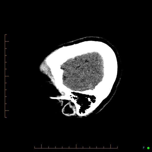 File:Cerebral arteriovenous malformation (AVM) (Radiopaedia 78162-90706 A 9).jpg