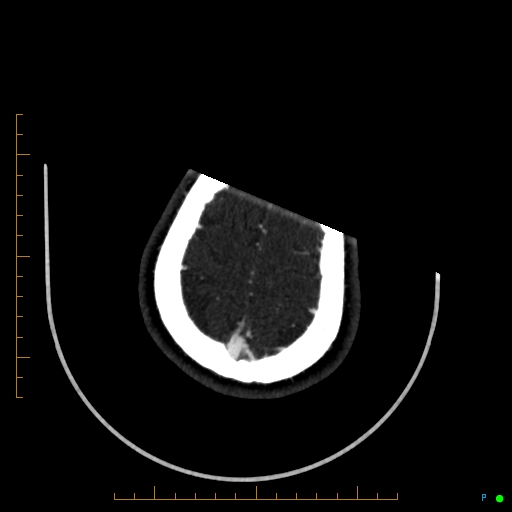 Cerebral arteriovenous malformation (AVM) (Radiopaedia 78162-90706 Axial CTA 241).jpg