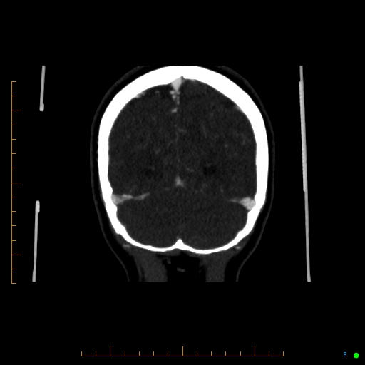 Cerebral arteriovenous malformation (AVM) (Radiopaedia 78162-90706 Coronal CTA 23).jpg