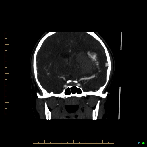 Cerebral arteriovenous malformation (AVM) (Radiopaedia 78162-90706 Coronal CTA 60).jpg