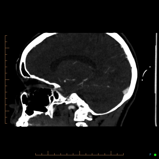 Cerebral arteriovenous malformation (AVM) (Radiopaedia 78162-90706 Sagittal CTA 49).jpg