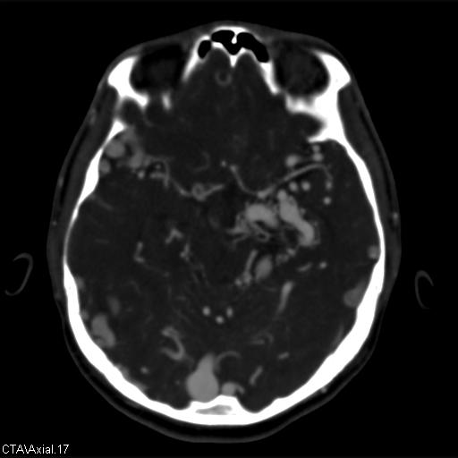 Cerebral arteriovenous malformation (Radiopaedia 28518-28759 B 17).jpg