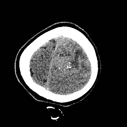 Cerebral arteriovenous malformation (Radiopaedia 79677-92887 Axial non-contrast 54).jpg