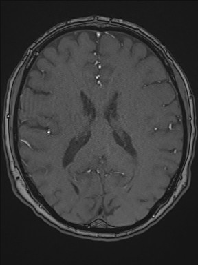 Cerebral arteriovenous malformation (Radiopaedia 84015-99245 Axial TOF 144).jpg