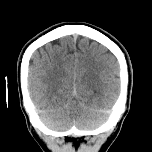 Cerebral arteriovenous malformation (Spetzler-Martin grade 2) (Radiopaedia 41262-44076 Coronal non-contrast 51).png