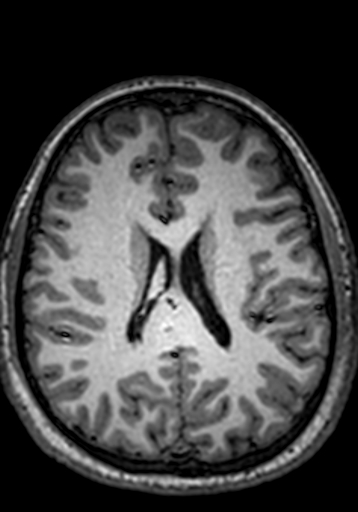 Cerebral arteriovenous malformation at posterior body of corpus callosum (Radiopaedia 74111-84925 Axial T1 109).jpg