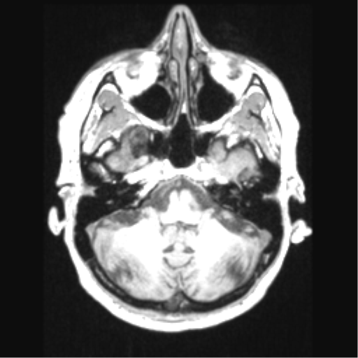 Cerebral arteriovenous malformation with hemorrhage (Radiopaedia 34422-35737 Axial T1 18).png