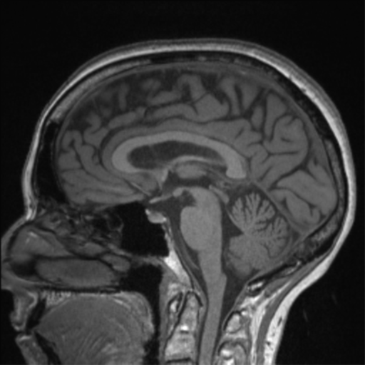 Cerebral arteriovenous malformation with hemorrhage (Radiopaedia 34422-35737 Axial T1 79).png