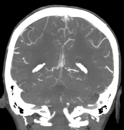 File:Cerebral arteriovenous malformation with lobar hemorrhage (Radiopaedia 44725-48511 B 40).png