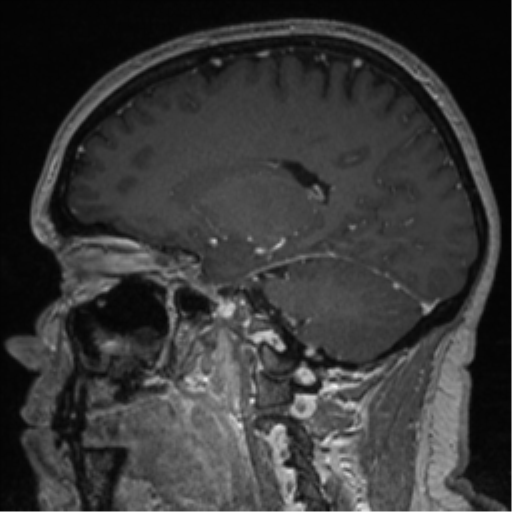 Cerebral cavernoma and development venous anomaly (Radiopaedia 37603-39482 Sagittal T1 C+ 58).png