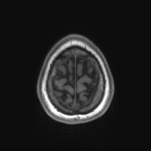 Cerebral cavernous venous malformation (Radiopaedia 70008-80021 Axial T1 89).jpg