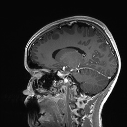 Cerebral cavernous venous malformation (Radiopaedia 70008-80021 Sagittal T1 C+ 29).jpg