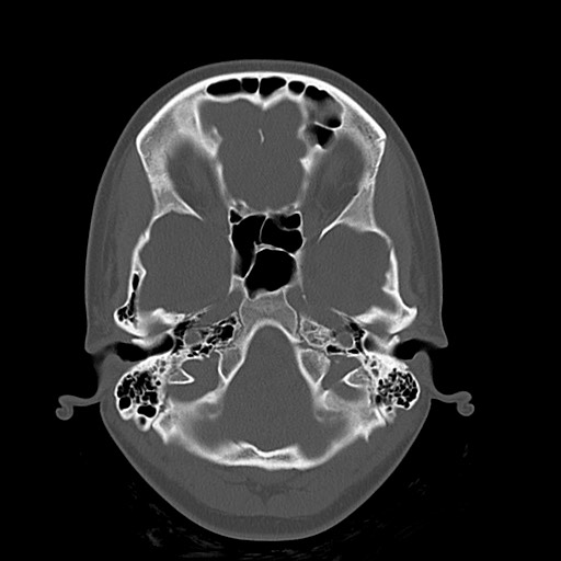 Cerebral cavernous venous malformation (Radiopaedia 70008-80022 Axial bone window 7).jpg