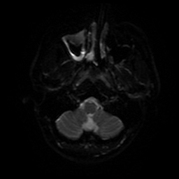 File:Cerebral cavernous venous malformation (Zabramski type II) (Radiopaedia 85511-101198 Axial DWI 71).jpg