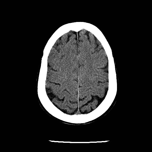 Cerebral edema (evolution in time) (Radiopaedia 19418-19441 non-contrast 73).jpg