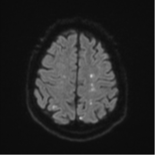 File:Cerebral embolic infarcts (embolic shower) (Radiopaedia 57395-64342 Axial DWI 64).png