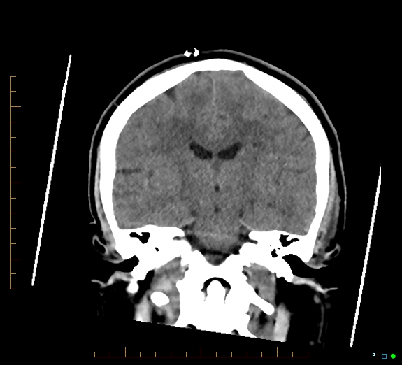 Cerebral fat embolism (Radiopaedia 85521-101220 Coronal non-contrast 35).jpg
