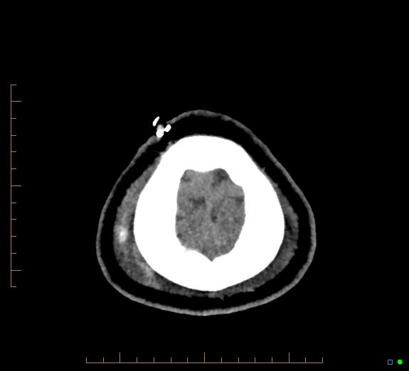 Cerebral fat embolism (Radiopaedia 85521-101224 Axial non-contrast 49).jpg