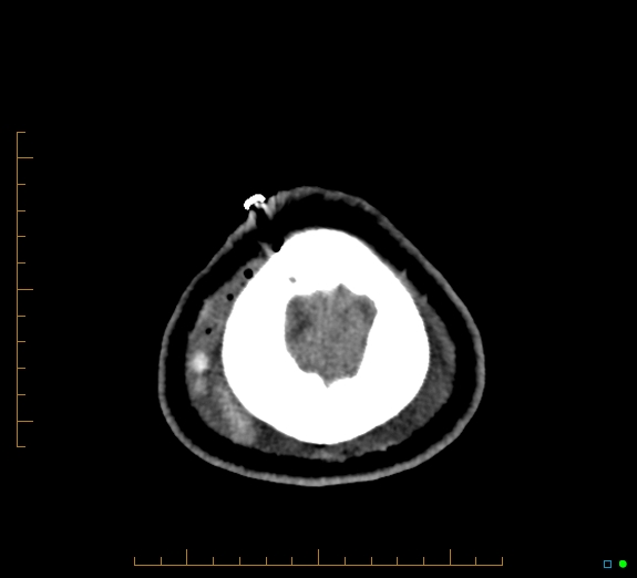 Cerebral fat embolism (Radiopaedia 85521-101224 Axial non-contrast 50).jpg