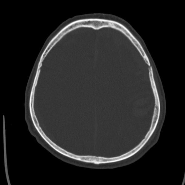 Cerebral hemorrhagic contusions (Radiopaedia 23145-23188 Axial bone window 40).jpg