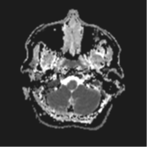 File:Cerebral metastases mimicking abscesses (Radiopaedia 45841-50131 Axial ADC 5).png