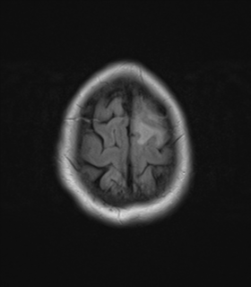 File:Cerebral metastases mimicking abscesses (Radiopaedia 45841-50131 Axial FLAIR 26).png