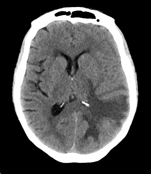 File:Cerebral metastasis (Radiopaedia 46744-51247 Axial non-contrast 16).png