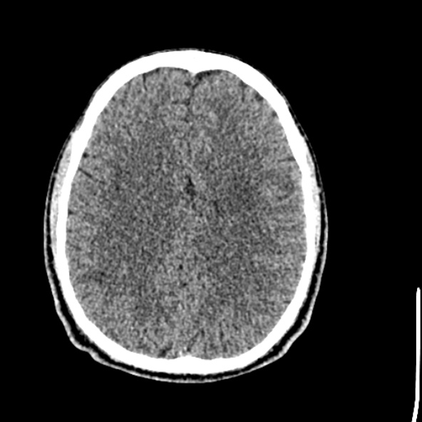 Cerebral toxoplasmosis (Radiopaedia 53993-60131 Axial non-contrast 53).jpg