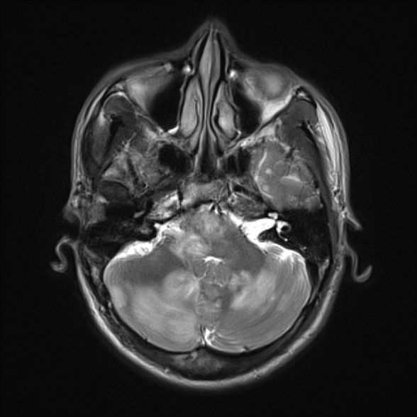 File:Cerebral toxoplasmosis (Radiopaedia 53993-60132 Axial T2 6).jpg