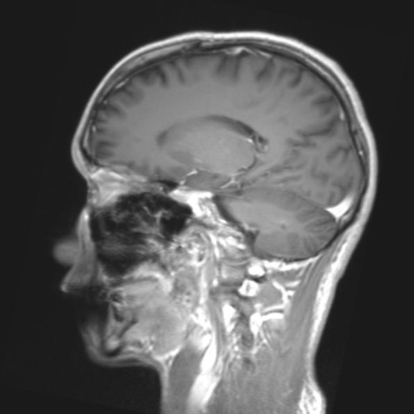 File:Cerebral toxoplasmosis (Radiopaedia 53993-61435 Coronal T1 21).jpg