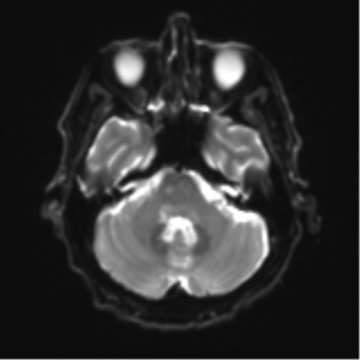 Cerebral toxoplasmosis (Radiopaedia 54575-60804 Axial DWI 10).png